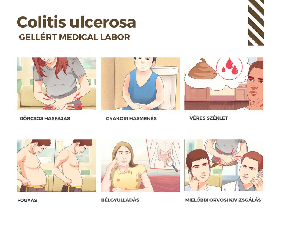 
<span>Vastagbélgyulladás / Colitis ulcerosa</span>

