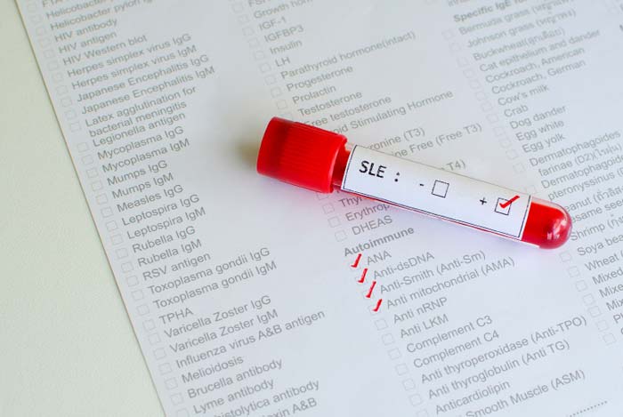 
<span>Az ANA és ENA vizsgálatok klinikai jelentősége</span>
