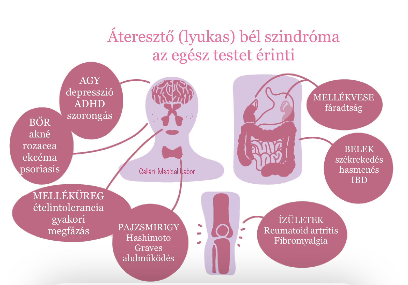 Áteresztő bélszindróma és a Hashimotó