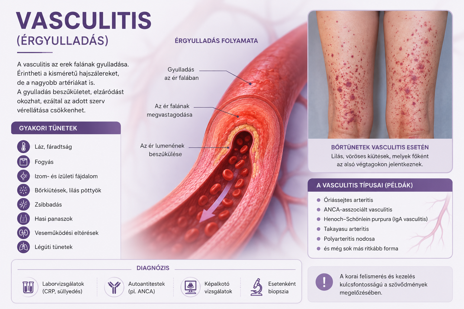 Érgyulladás- vasculitis