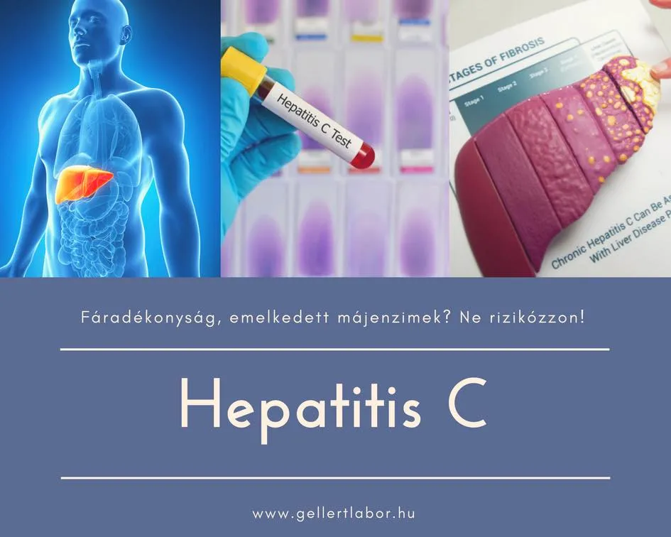 HCV - Hepatitis C fertőzés, gyakoribb, mint gondolná! 