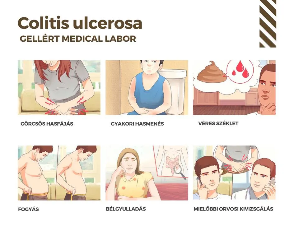 Vastagbélgyulladás / Colitis ulcerosa