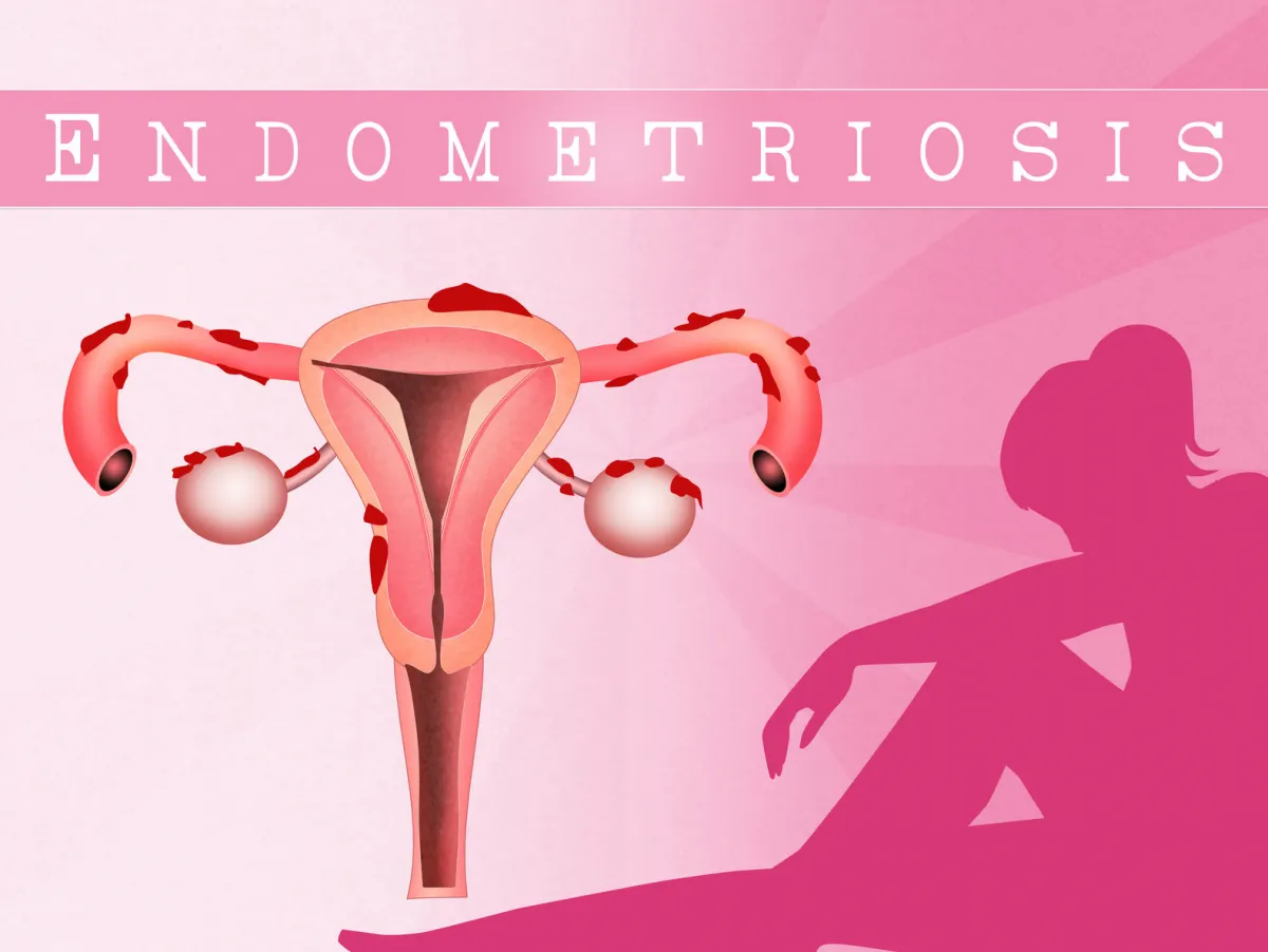 Endometriózis