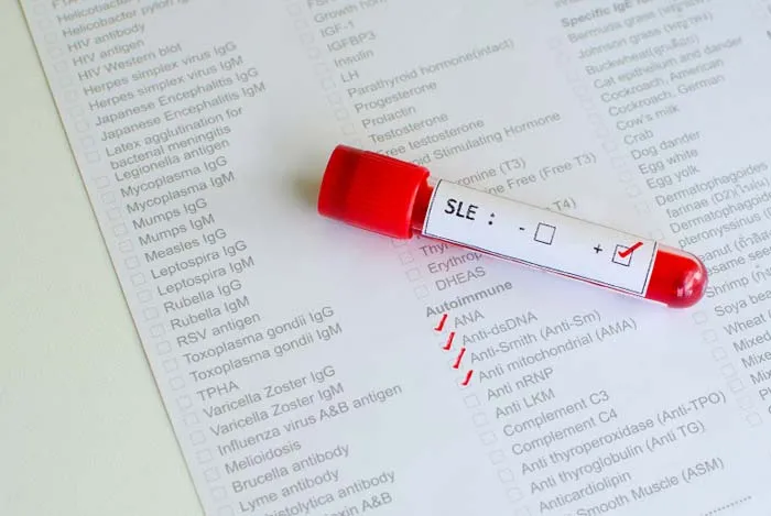 Az ANA és ENA vizsgálatok klinikai jelentősége
