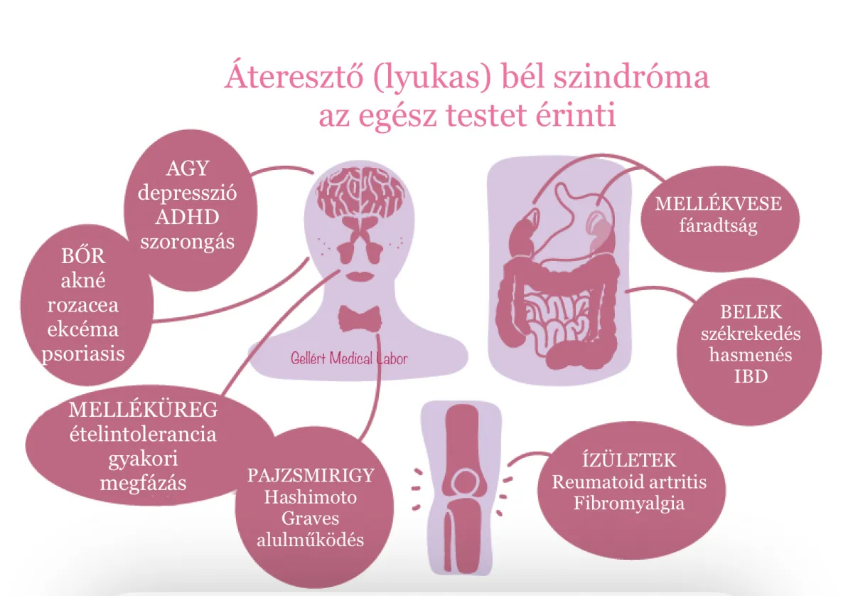 Áteresztő bélszindróma és a Hashimotó