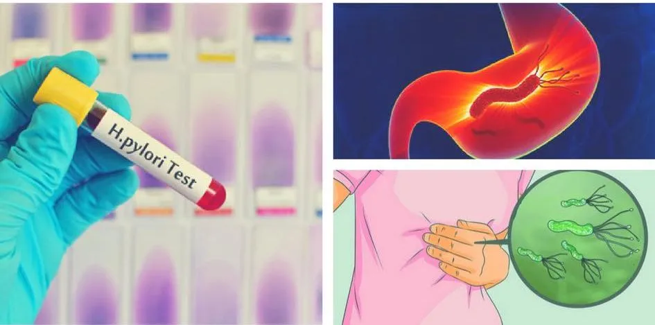 Helikobakter pylori 